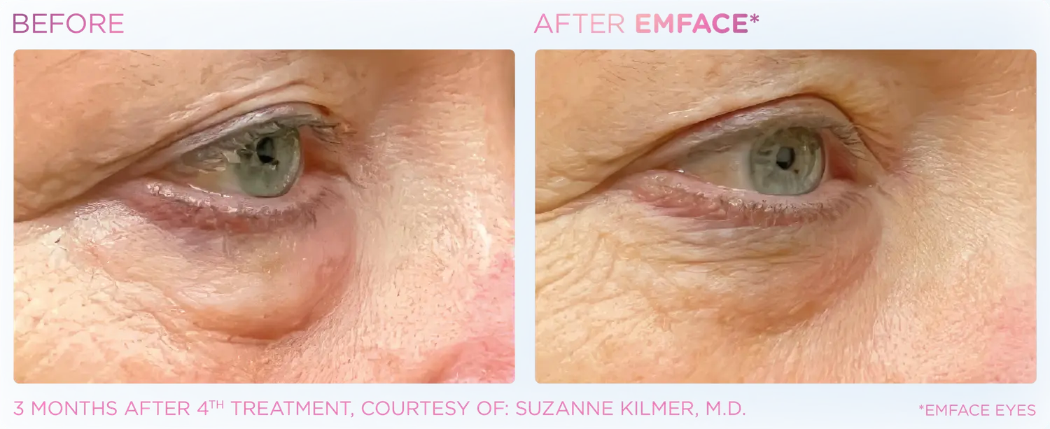 Reduce Eye Bags