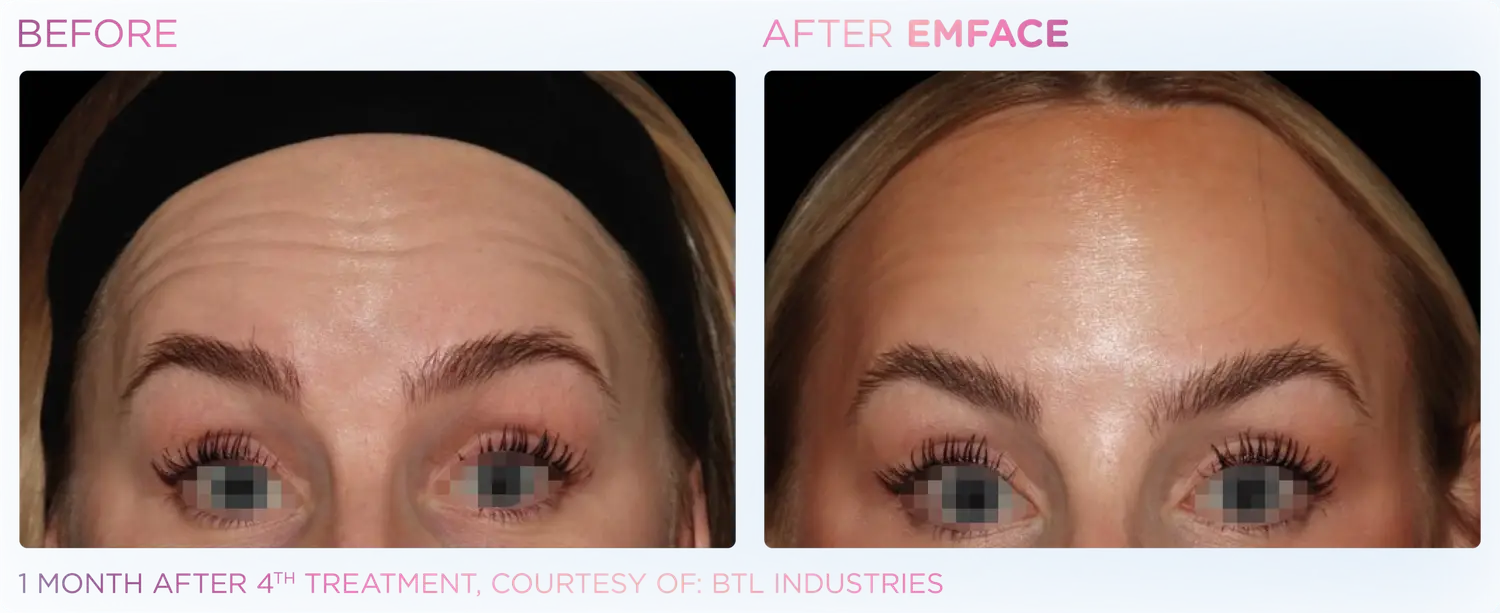 Reduce Forehead Lines