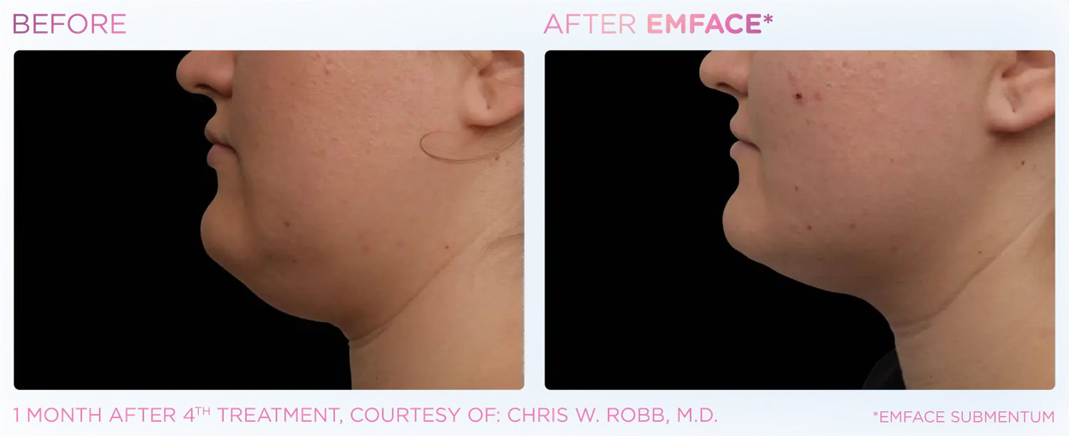 Lift Chin / Submentum