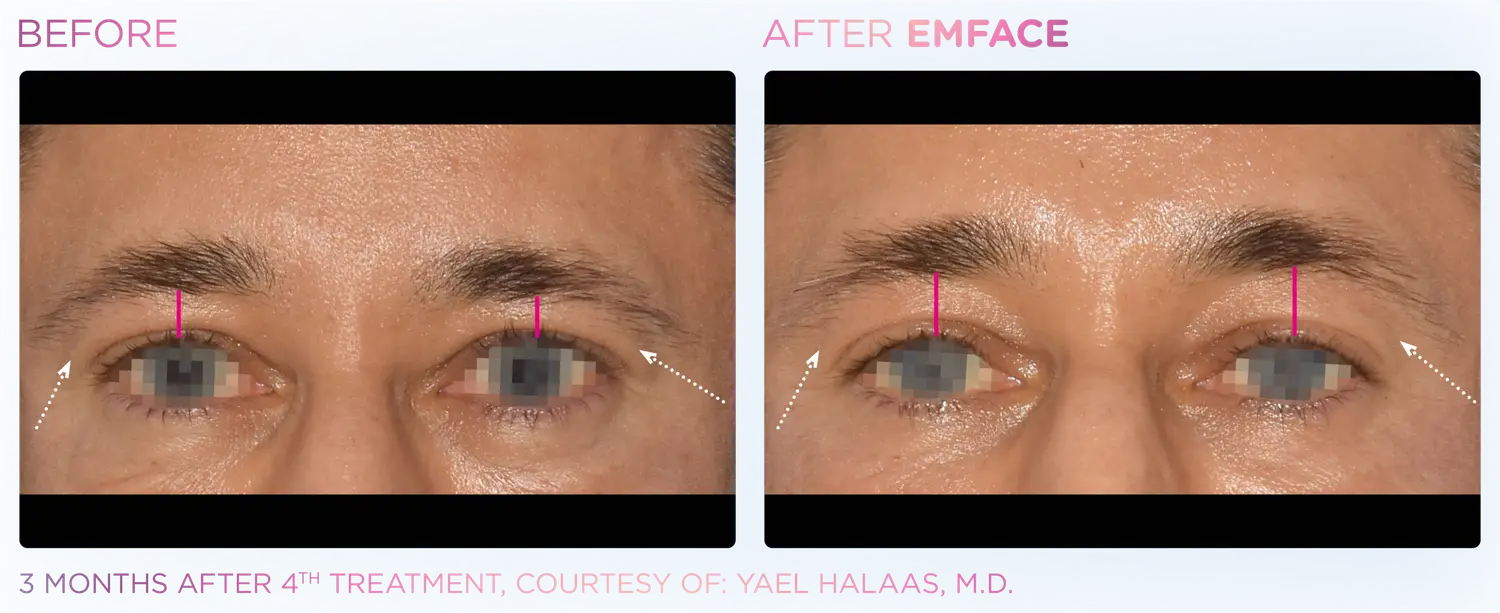 Lift Frontalis for Brighter Eyes